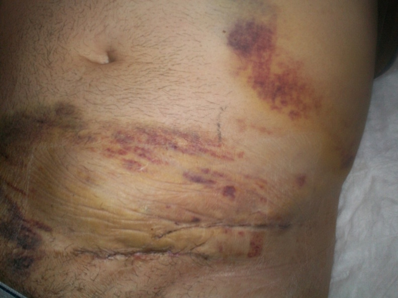 Wound healing after treatment